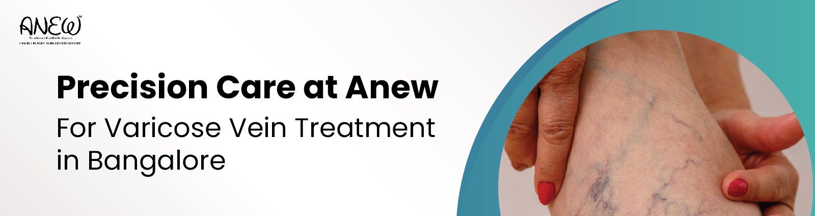  varicose veins treatment in bangalore